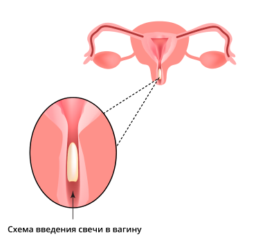 Бактериальный вагиноз - лечение смешанных вагинальных инфекций.